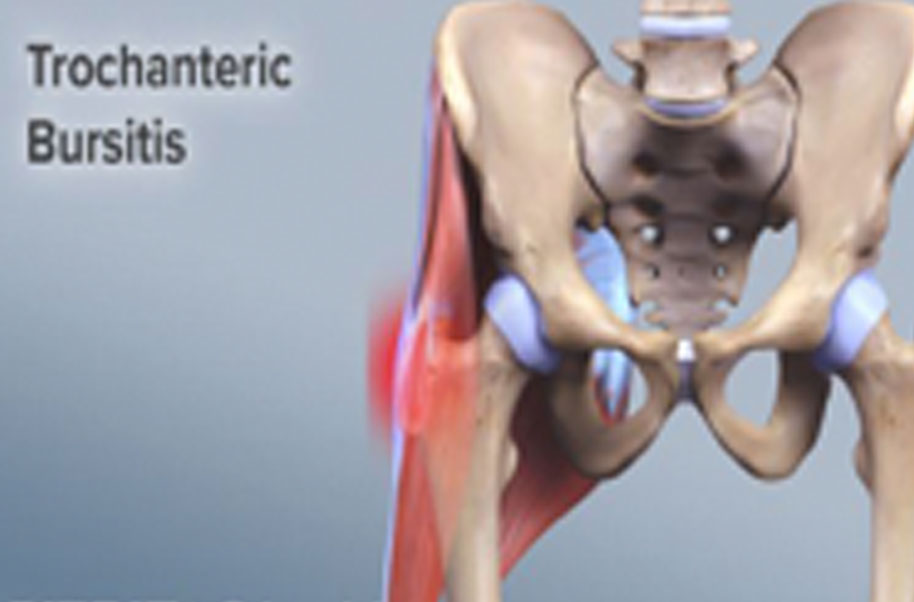 what causes bursitis in the hip