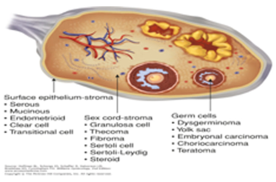 Ovarian Sex Cord Stromal Tumour