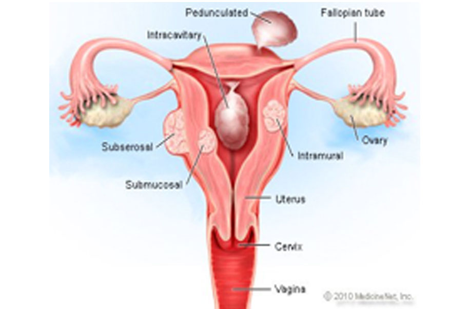 In malay uterus Uterine Fibroids