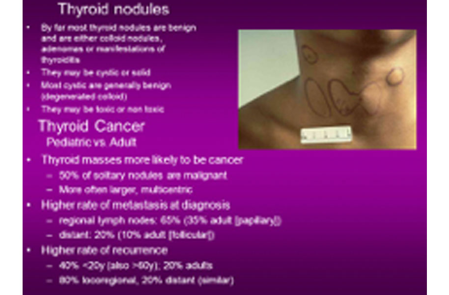 Non Cancerous Colloid Thyroid Nodule