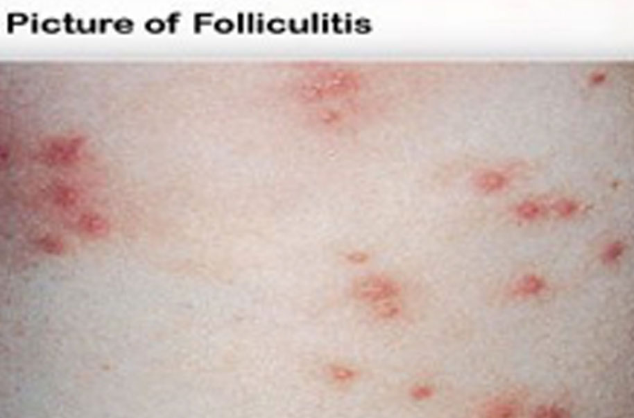 Folliculitis