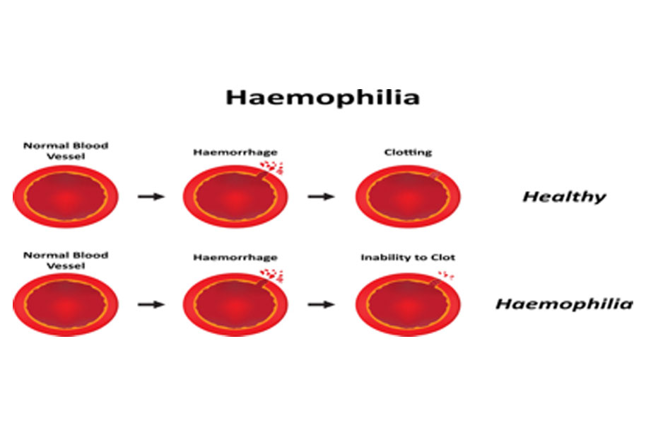 Christmas Disease Haemophilia