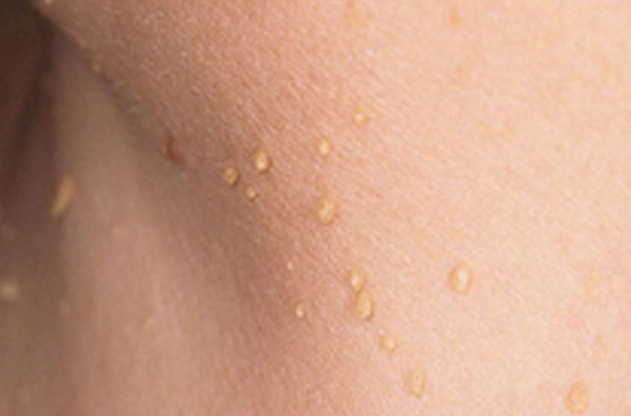 Acrochorda (Skin Tag)