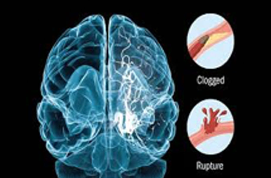 Hemiparesis