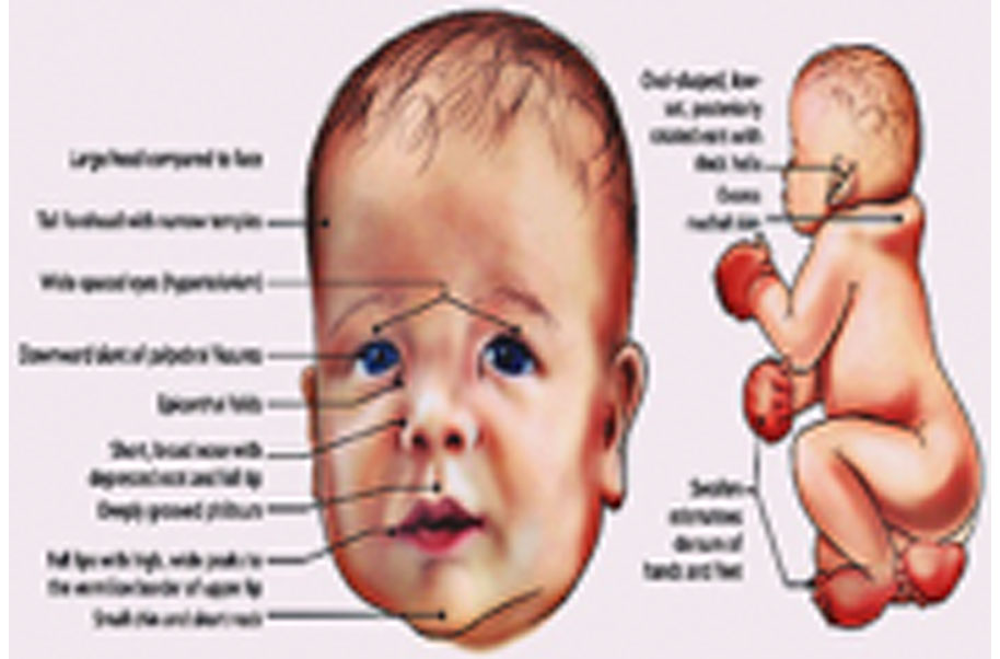 Noonan Syndrome Neonate Spectrum Of Mutations And Genotype phenotype