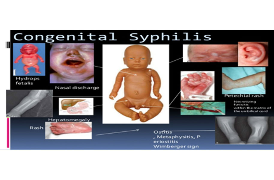 saddle nose syphilis baby