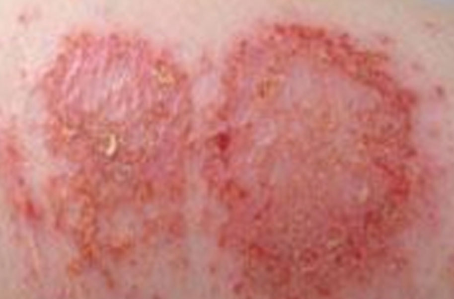 Discoidal Eczema