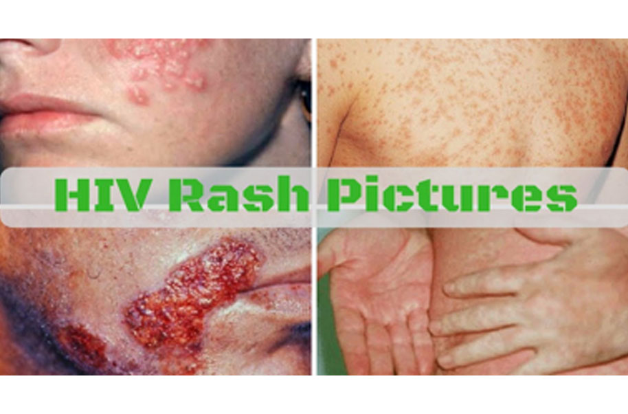 hiv-rash-pictures
