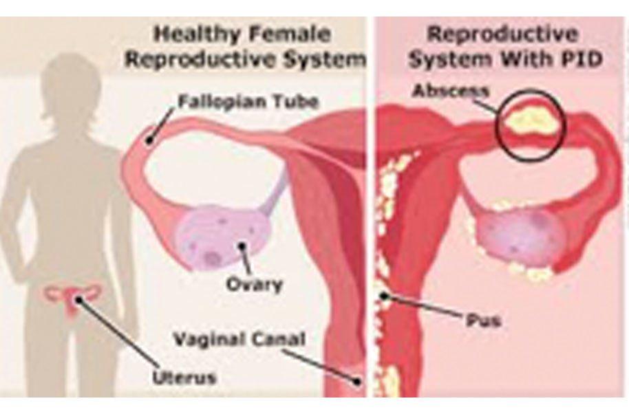 Pelvic Inflammatory Disease Diagram Pelvic Inflammatory Disease Diagram