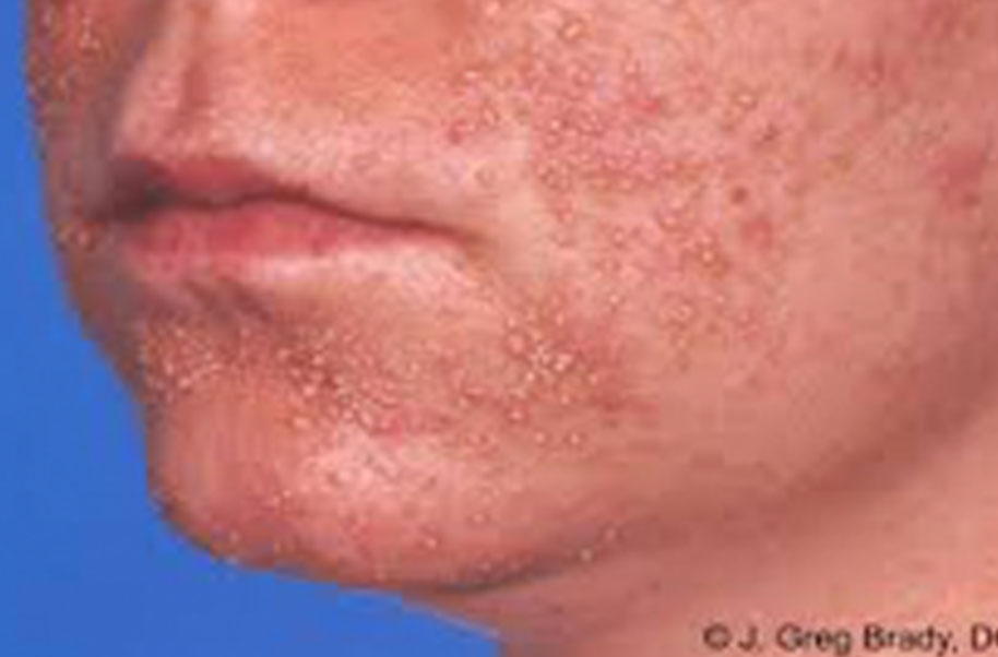 Folliculitis