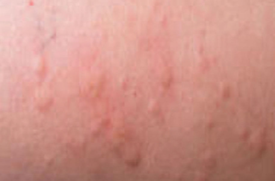 Hivesskin Rash Rash Urtication Nettle Rash Hypersensitivity