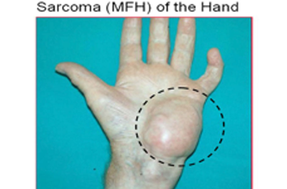 Sarcoma cancer in hand, Prevenirea agentului antihelmintic