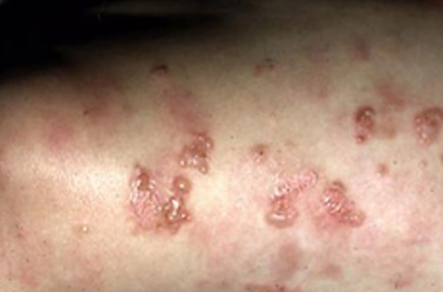 Dermatitis Herpetiformis