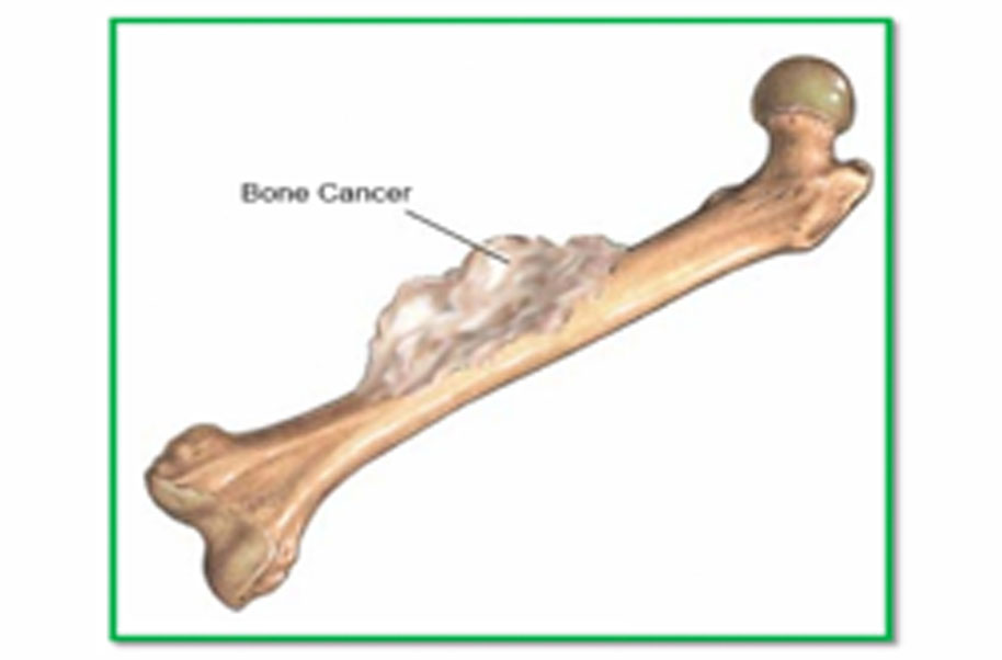 Sarcoma cancer of the bone, Sarcoma cancer of the bone