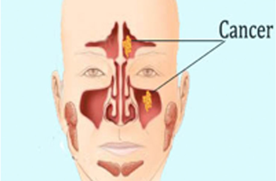 Hpv sinus tumor